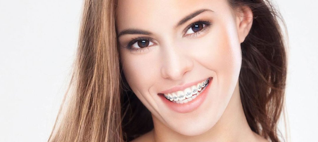 Ortodoncia en Adultos: Una Sonrisa Perfecta a Cualquier Edad con SpecialDent Marbella